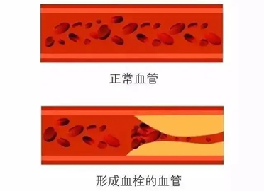 说出来你可能不信，汽车会得“血栓”！